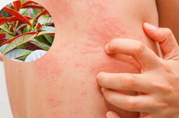 Chữa viêm da cơ địa từ những cây có sẵn trong vườn nhà